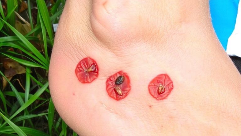 flea bites target ankles