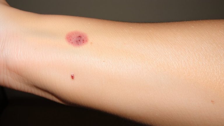 genetic immunity to bed bugs