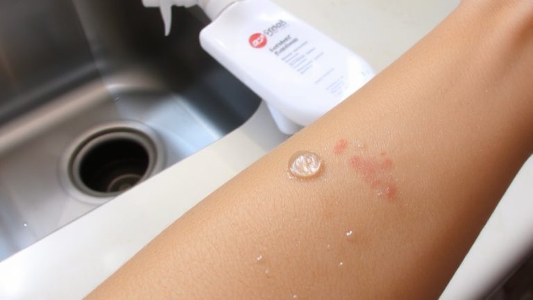 propylene glycol skin irritation